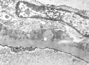 M,39y. | membranous glomerulopathy M,39y. | membranous glomerulopathy